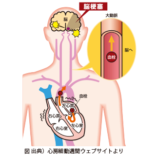 心房細動とは